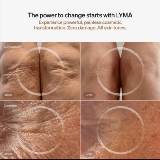 Lyma Laser kit